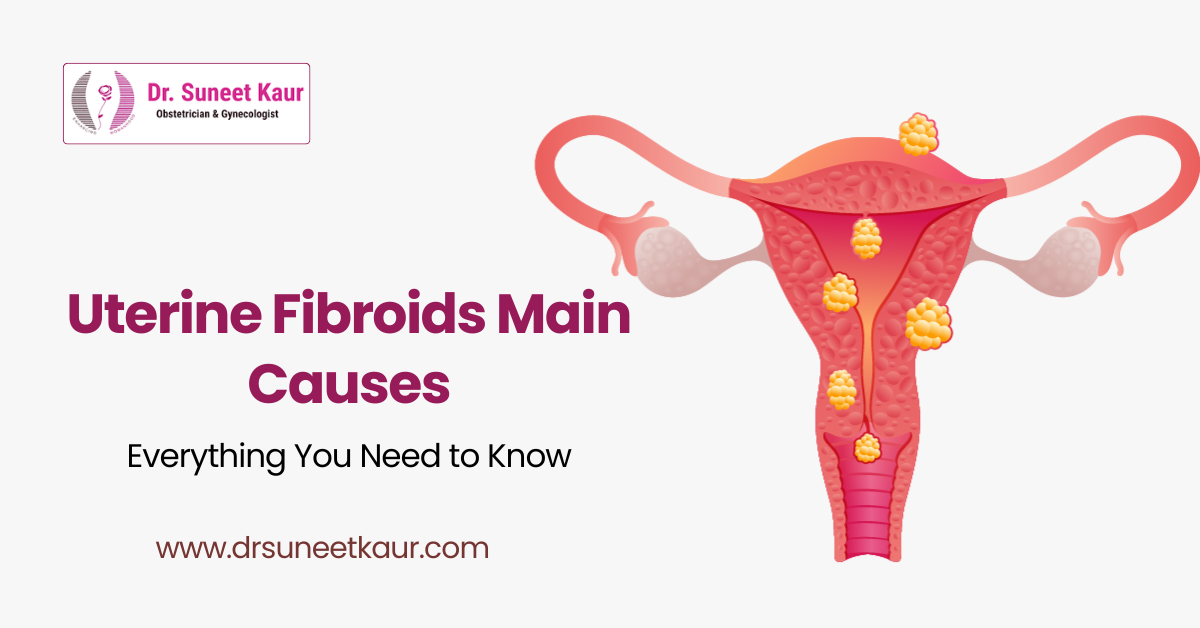 Uterine Fibroids Main Causes: Everything You Need to Know