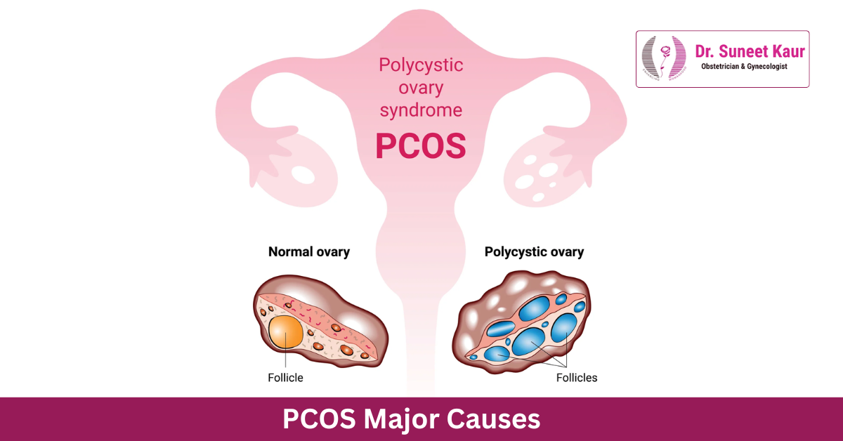 PCOS Major Causes – Understanding the Root of Hormonal Imbalance in Women