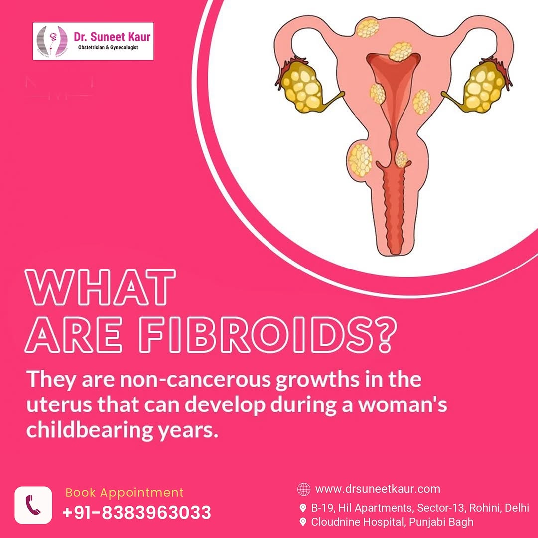 What are Fibroids?